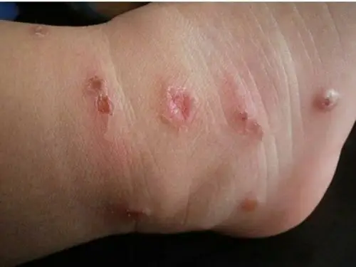 下身虫咬皮炎过敏的图片