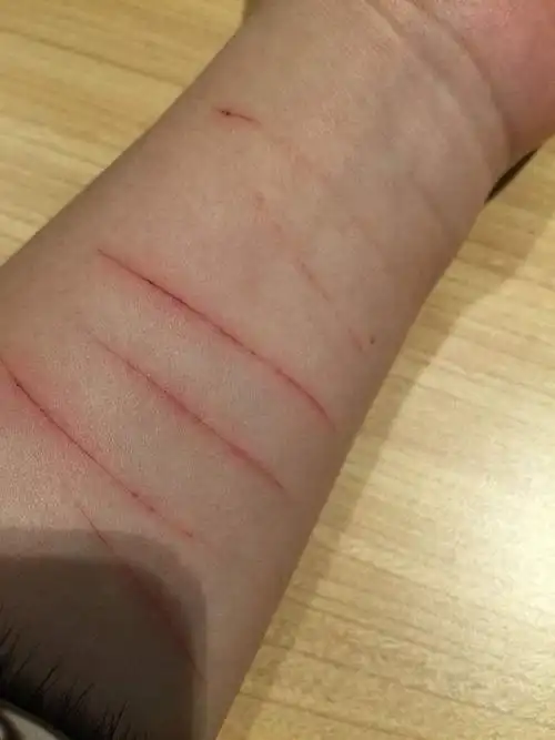 割伤图片手腕,手腕被割伤的伤口图片-图片大观-奇异网