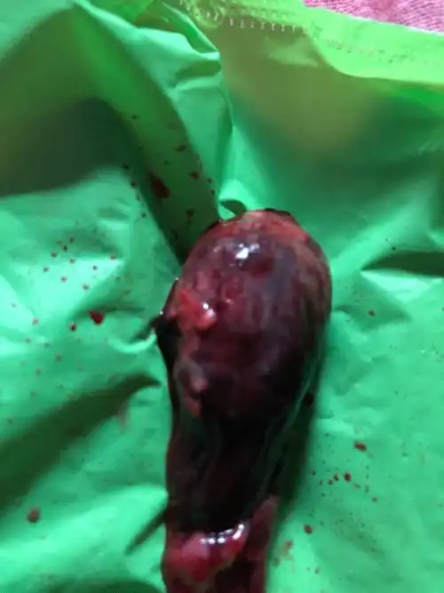 请问这个是孕囊吗?出血怀疑先兆流产腹痛一夜排出来的.