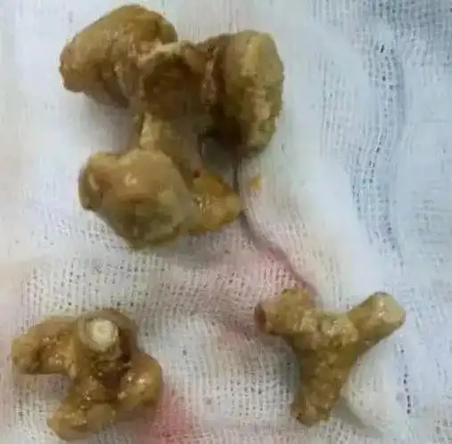 根据尿结石成分及特性来区分,以草酸钙结石最常见,磷酸盐,尿酸盐,碳酸