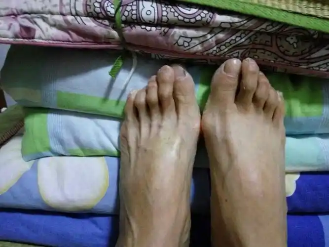 妈妈今年50岁,患有慢性肾炎和高血压,3年前一只脚的脚背出现肌肉萎缩