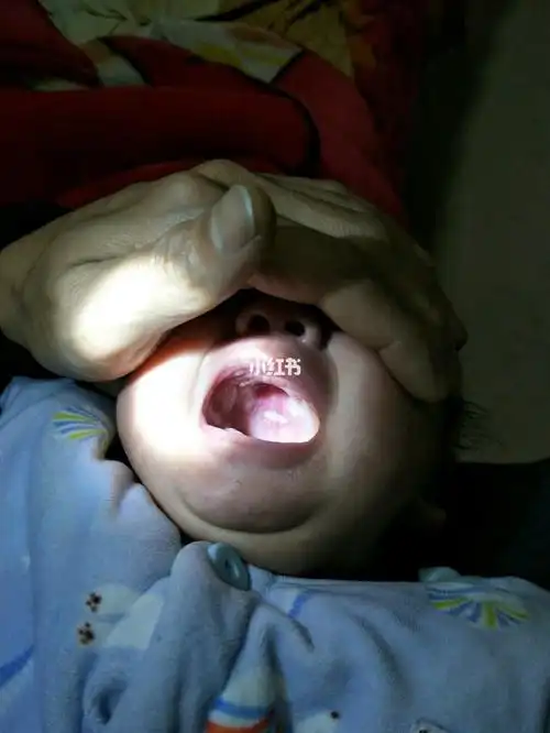 宝宝口腔上颚凹陷,刚开始怀疑是隐形腭裂,检查医生说不是,宝妈们,有