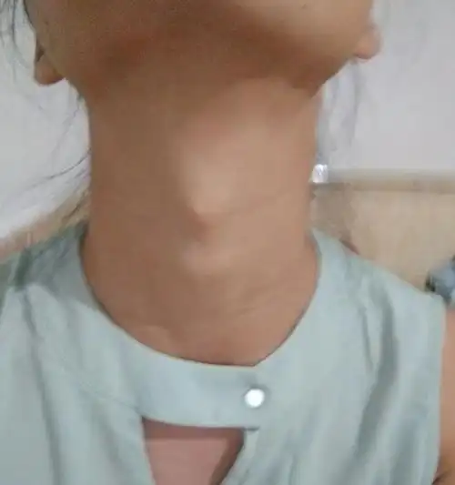 文梦洋好像有喉结照片女人喉结突出说明什么