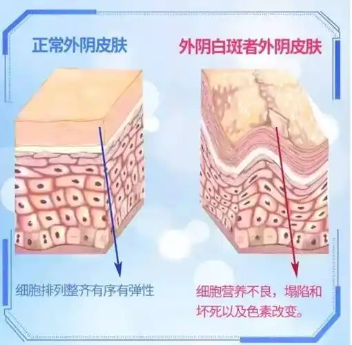 外阴白斑是一种慢性顽固性疾病,指女性外阴皮肤黏膜因营养障碍而引起