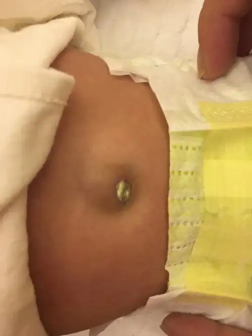 肚脐眼多久能好,这样凸起正常吗?