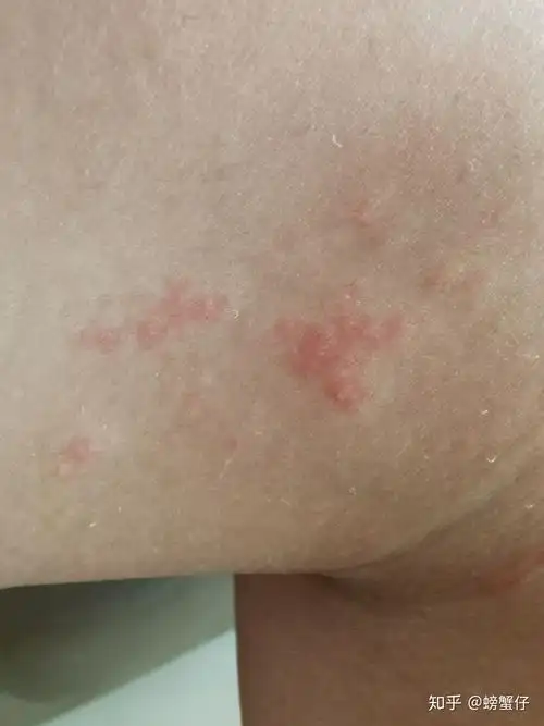 我的丘疹性荨麻疹差不多三个月