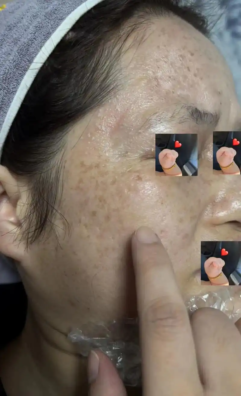 一晒就反黑?我家客户宝宝祛斑第130天的 - 抖音