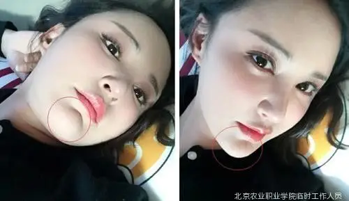 打死不承认整容的张歆艺,下巴这道巨大的坑怎么解释?