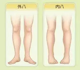 孩子行走时表现的"内八字"或者"外八字"的问题,实际上是下肢出现旋转