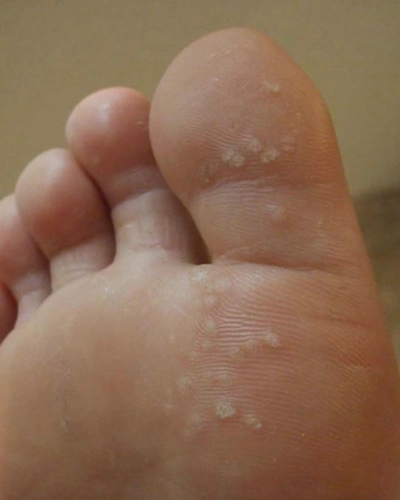 疣的形成 脱疣治疗有哪几种?