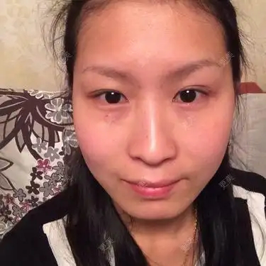 额头窄不够圆润要怎么改善呢医生您好请问我的情况可以怎么改善呢