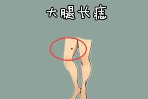 女孩右大腿有胎记好不好 什么部分长的痣好