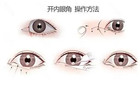 开了眼角反而变丑了怎么矫正给你开眼角不踩雷的几点建议