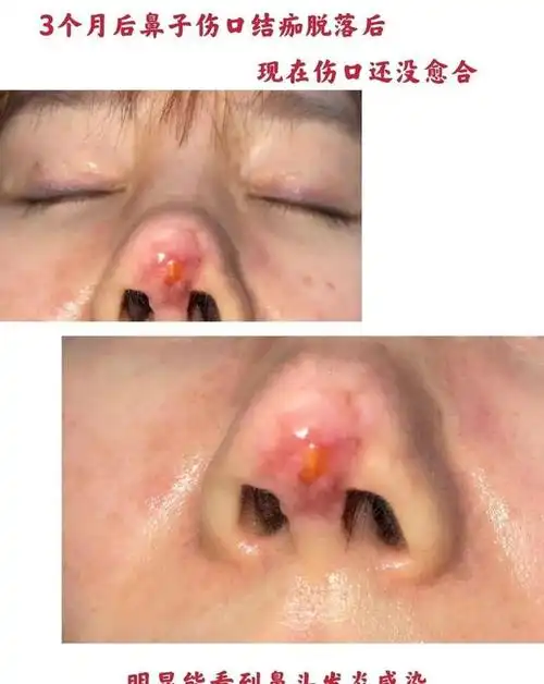 被整成"狗鼻子",又一女演员因整容失败导致鼻子坏死