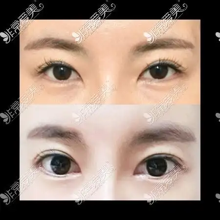 韩国icon开眼角前后对比图
