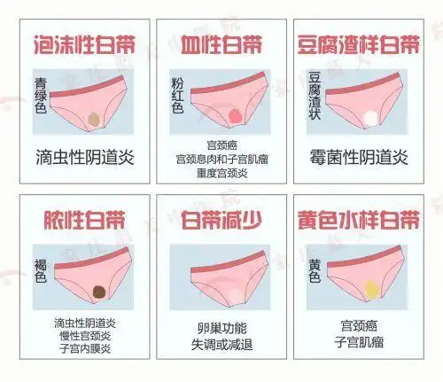 宫内节育器位置下移,月经前期和排卵期,都会出现白带褐色