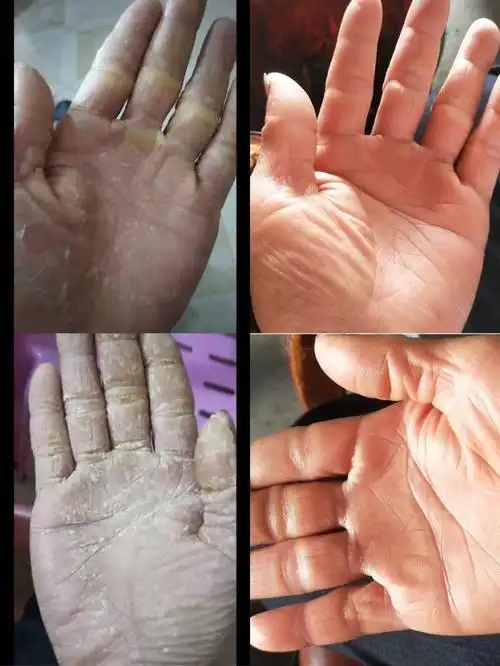 各种手癣可治疗[微笑]