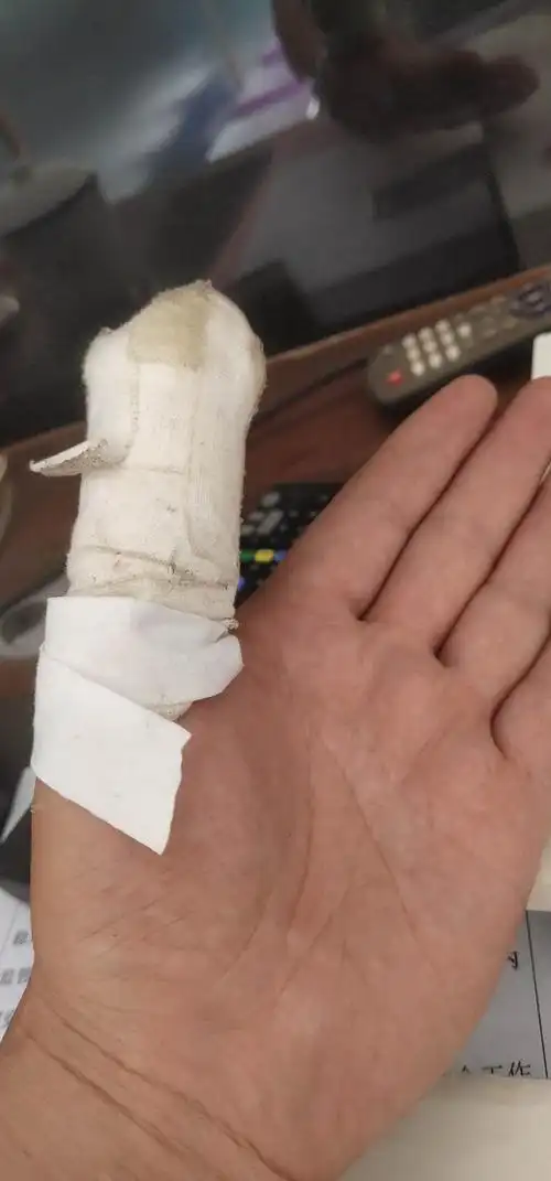手指受伤后的故事
