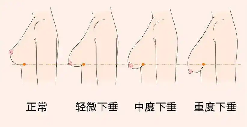 哺乳后乳房下垂,怎么办?