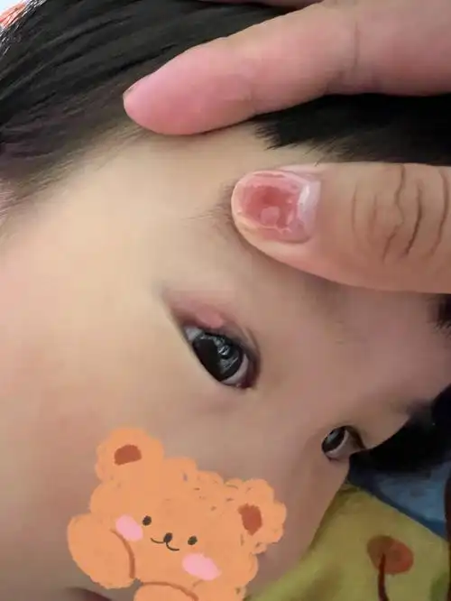 笔记1霰粒肿记录坚决不开刀