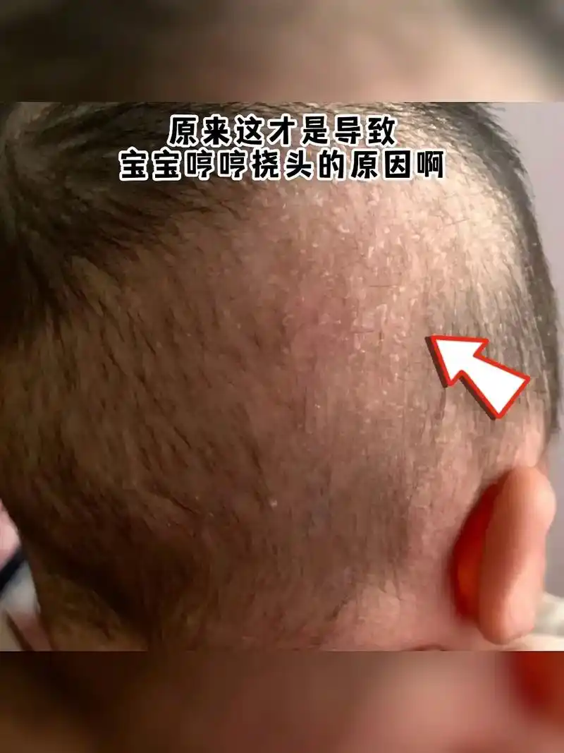 宝宝头上从出生后就有点白色皮屑,后来变成了 - 抖音