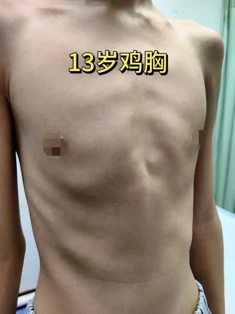 醒图 #鸡胸 #微创手术 #随拍 #儿童胸外科岳芳主任 - 抖音