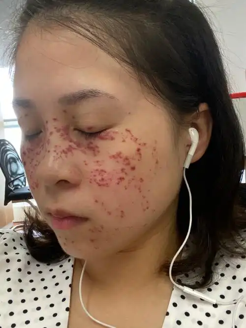 激光祛斑后第一天