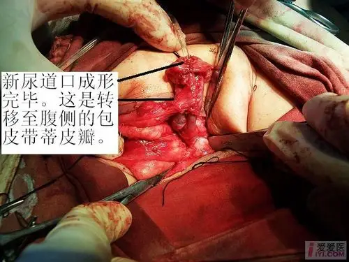 【原创】阴囊型尿道下裂,duckett duplay术式!