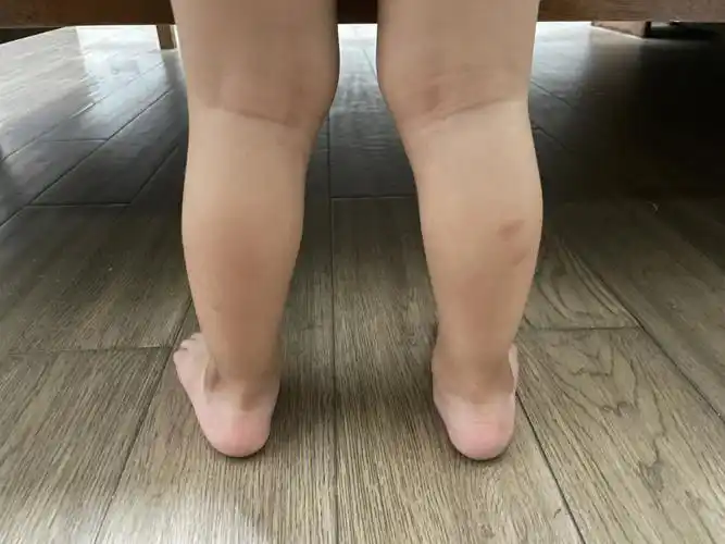 宝宝足外翻两周岁的宝宝,这个腿型正常吗,而且看着是不是有点足头翻