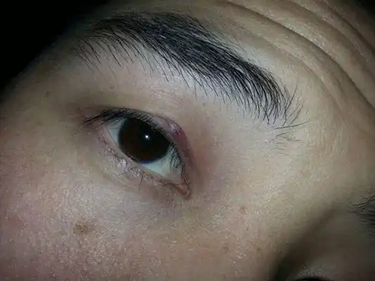 长针眼的症状图片 (17)_有来医生