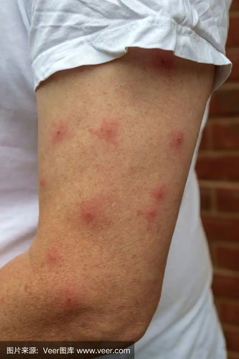 蚊子叮咬后的过敏反应