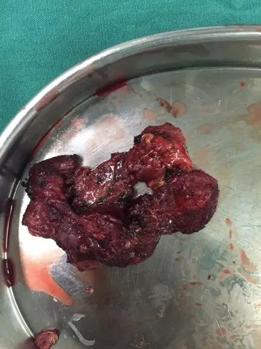 右侧清扫的淋巴结组织