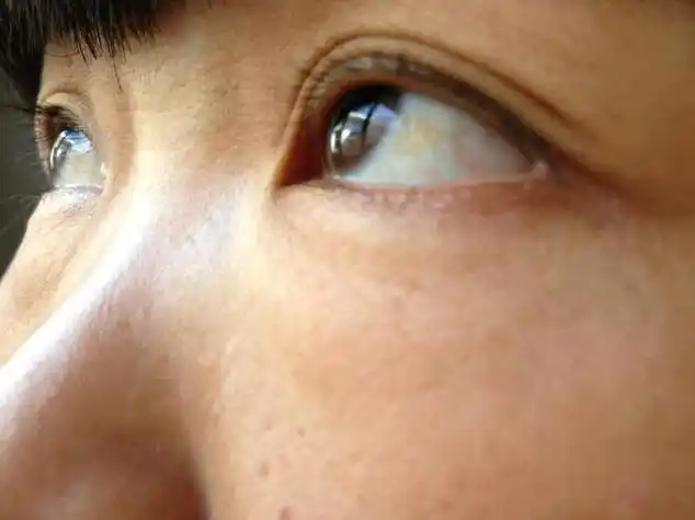 眼睛的白眼球有点发黄怎么回事