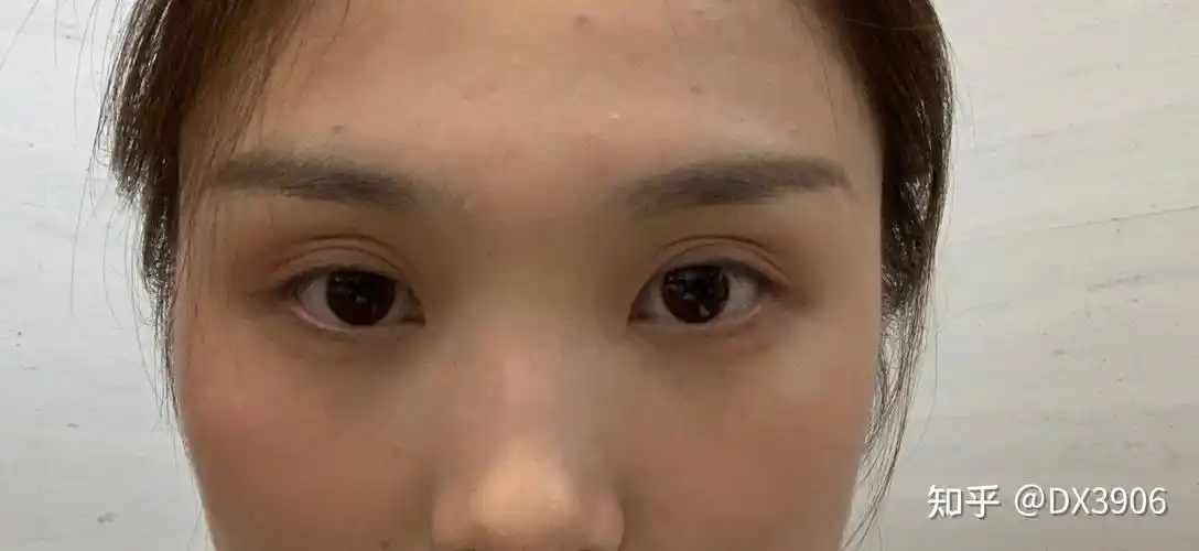 术后六个月出现三眼皮.两只眼睛不一样情况.