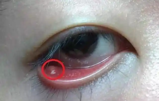 起病没有外麦粒肿发病那么急,症状初期有眼睑发红,轻度肿胀,后期会