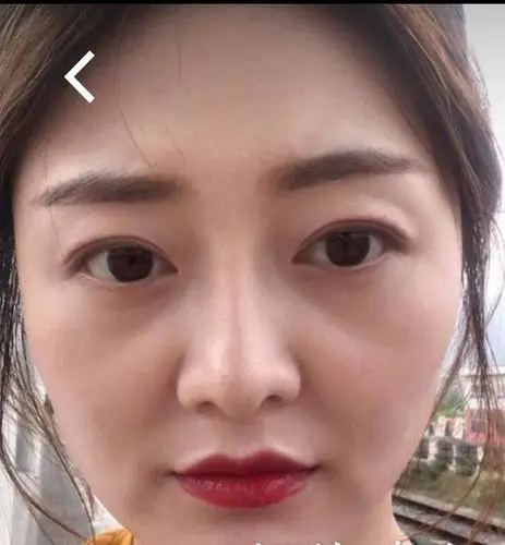 长了好多年的 印第安纹 好显老 有什么办法改善吗 求解答