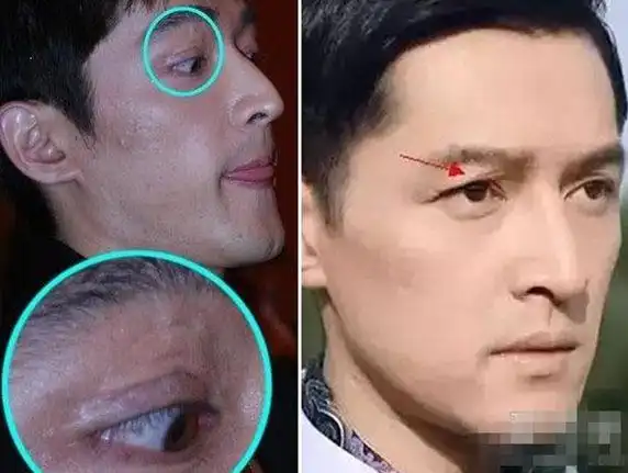 【图】胡歌右眼皮怎么了? 车祸受伤严重脸部修复估计超百万