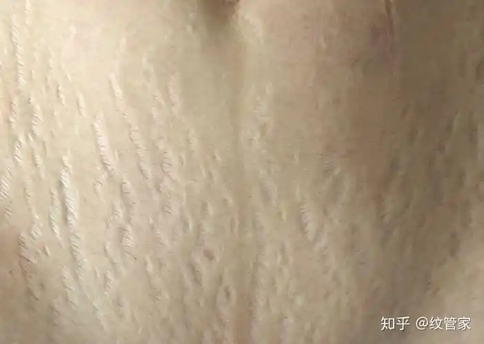 你的妊娠纹处于什么阶段?