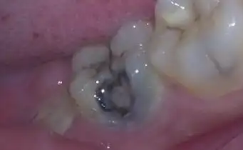 无痛治疗 龋齿|蛀牙|虫牙      3,深龋,即已经伤及到牙髓的牙齿,常