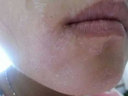 脸上长癣图片 (14)_有来医生