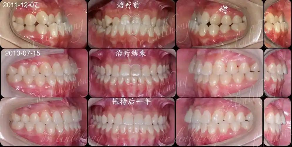 地包天女生不拔牙矫正,改善颞下颌关节紊乱