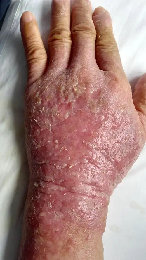 手癣还是什么请各位医生看看