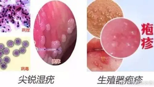 系带长尖锐湿疣怎么办