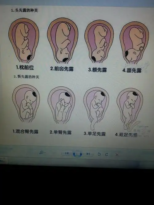 看图猜胎位,摸胎动猜胎位