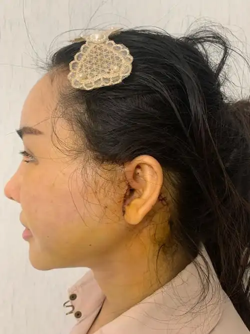 【术后第7天】大拉皮真的效果非常好,下颌缘部位明显_圈子-新氧美容