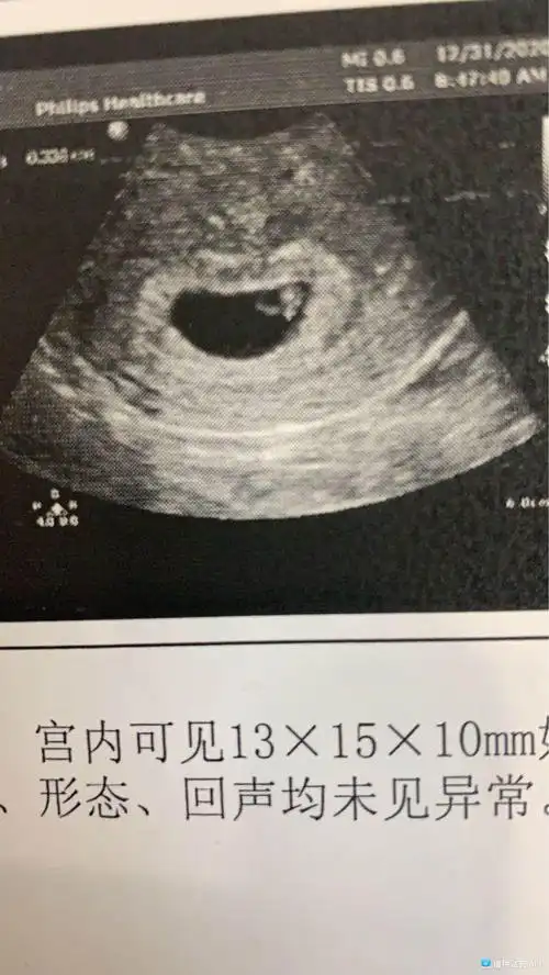 7周孕囊看男女!