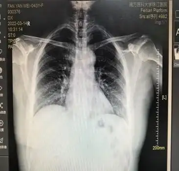 心大是一种病一男子熬了二十多年总算治好自己的牛心脏