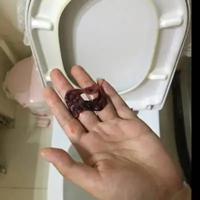 医生您好,我六周怀孕,但是彩超没看到孕囊,晚上上厕所排出东西,昨天的