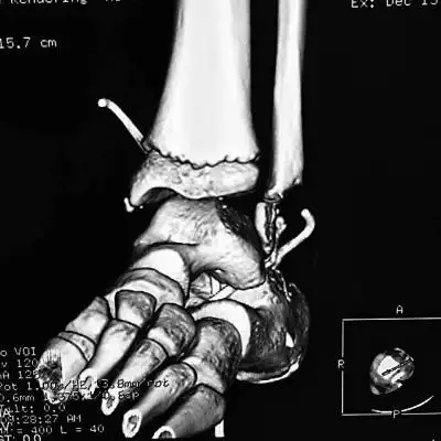 三维ct重建下显示小全脚踝处骨头缺损一大截(画圈处)医院供图