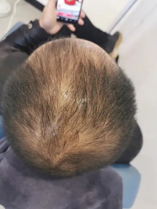 脂溢性脱发可以根治吗(头发掉的太严重怎么解决)